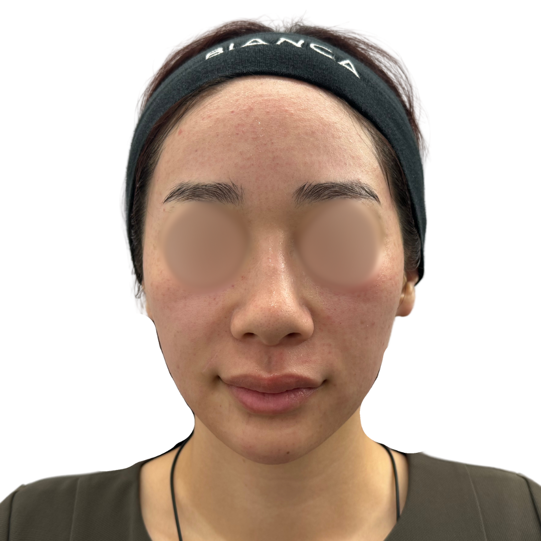 水光注射（スキンブースター）